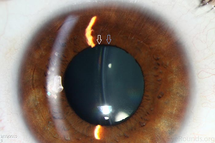 Slit lamp photograph of the Visian ICL.