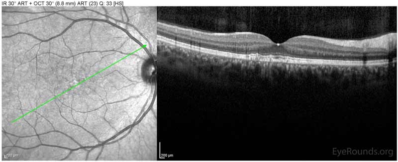 OCT-OD Optical coherence tomography of both eyes. In both eyes, there are small drusen above Bruch's membrane without sub- or intraretinal fluid.