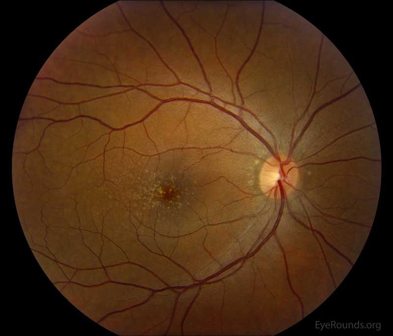 Color fundus photos centered on the macula and montage photos of both eyes. There were multiple small-medium sized, round, yellow drusen, some confluent in the macula and nasal to the nerve in both eyes. There was more clustering of drusen in the temporal macula. A few drusen were near, but not completely abutting the optic nerve.