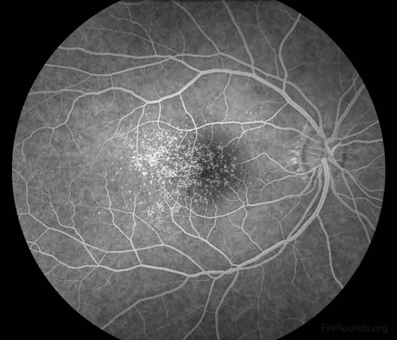 Representative fluorescein angiography photos of both eyes. There are more hyperfluorescent drusen than seen on fundoscopic exam.