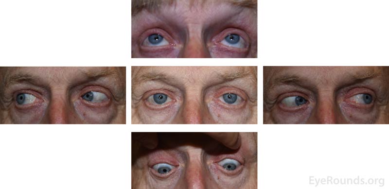 External 5-gaze photographs taken at the follow-up appointment four months after onset of symptoms demonstrating full extraocular motility and no ptosis bilaterally. 