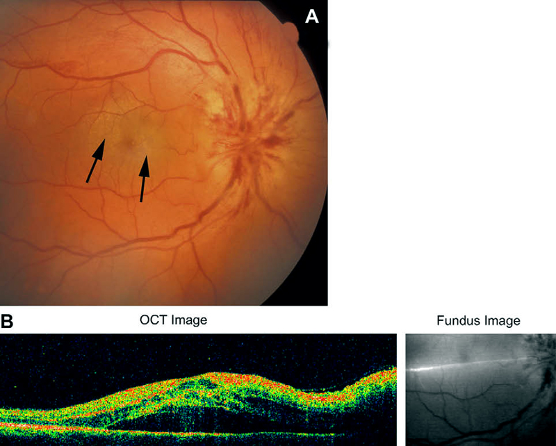 Fundus photograph (A) and OCT (B) of right eye with NA-AION and serous retinal detachment between the optic disc and the macula. In (A) arrows indicate the presence of lipid deposits in the central part of the macula.