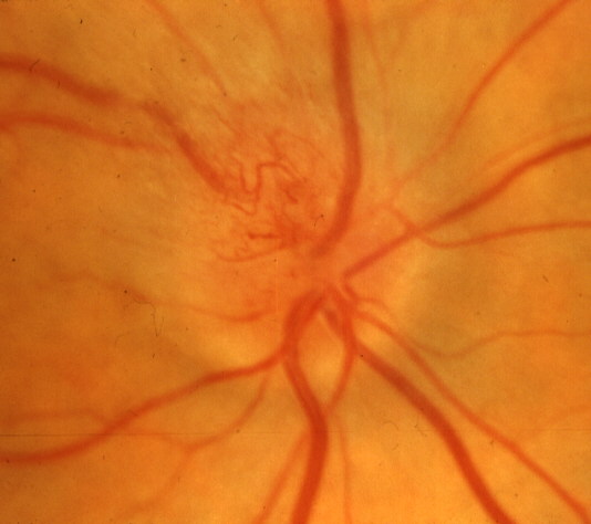 optic disc and prominent vessels in that region.