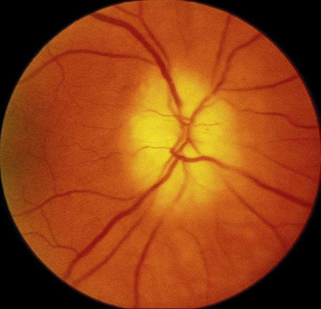 Fundus photograph of right eye with A-AION showing chalky white optic disc edema during the initial stages