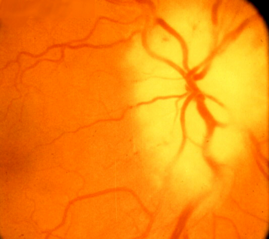 Fundus photograph of right eye with arteritic AION showing during the early phase the typical white optic disc edema.