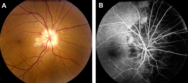 undus photograph (A) and fluorescein fundus angiogram (B) of right eye with A-AION and cilioretinal artery occlusion during the initial stages. (A) Fundus photograph shows chalky white optic disc edema with retinal infarct in the distribution of occluded cilioretinal artery. (B) Fluorescein fundus angiogram shows evidence of occlusion of the medial posterior ciliary artery and no filling of the cilioretinal artery.