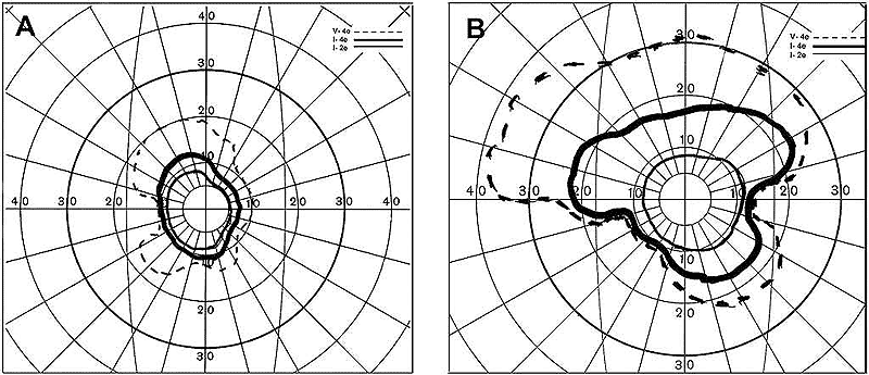 Visual fields of (A) right and (B) left eyes with arteritic PION, showing markedly constricted central visual fields, with complete loss of peripheral fields in both eyes