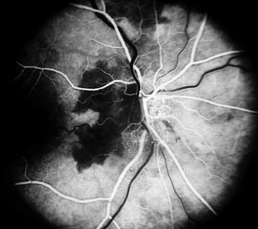 Fluorescein fundus angiogram. A. Shows filling defect in the peripapillary choroid and adjacent optic disc area