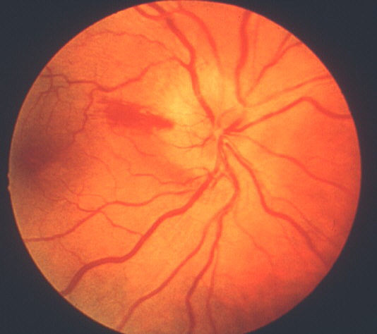 Fundus photograph of right eye during the early stages of AION, shows typical chalky white optic disc edema