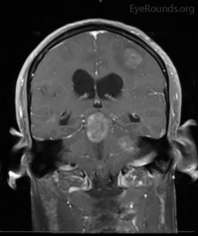 Magnetic resonance imaging (MRI) brain of the patient depicted in the video. Left image –T1 post-contrast, coronal with fat saturation showing a metastatic lesion involving the base of the thalamus, midbrain and upper pons. Right image – T2 axial showing a metastasis in the pons with likely involvement of bilateral MLF.