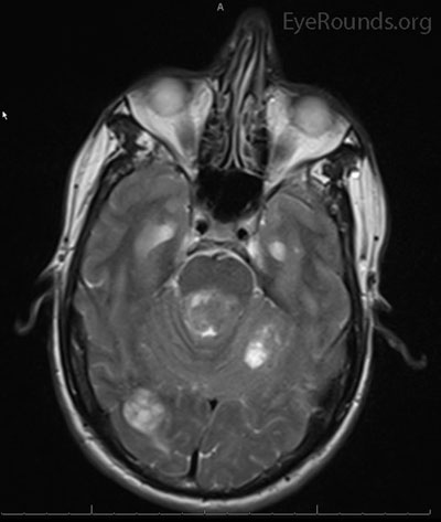 Magnetic resonance imaging (MRI) brain of the patient depicted in the video. Left image –T1 post-contrast, coronal with fat saturation showing a metastatic lesion involving the base of the thalamus, midbrain and upper pons. Right image – T2 axial showing a metastasis in the pons with likely involvement of bilateral MLF.
