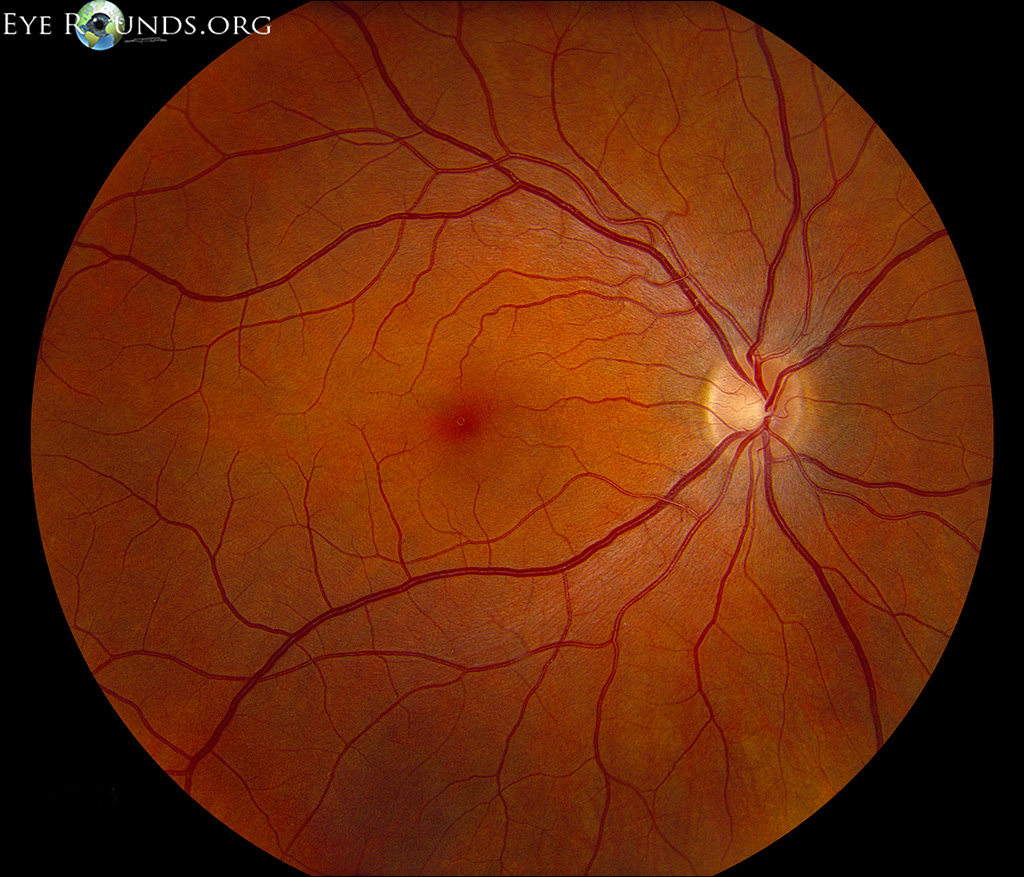 Figure 1. [The normal human retina fundus]. - Webvision - NCBI