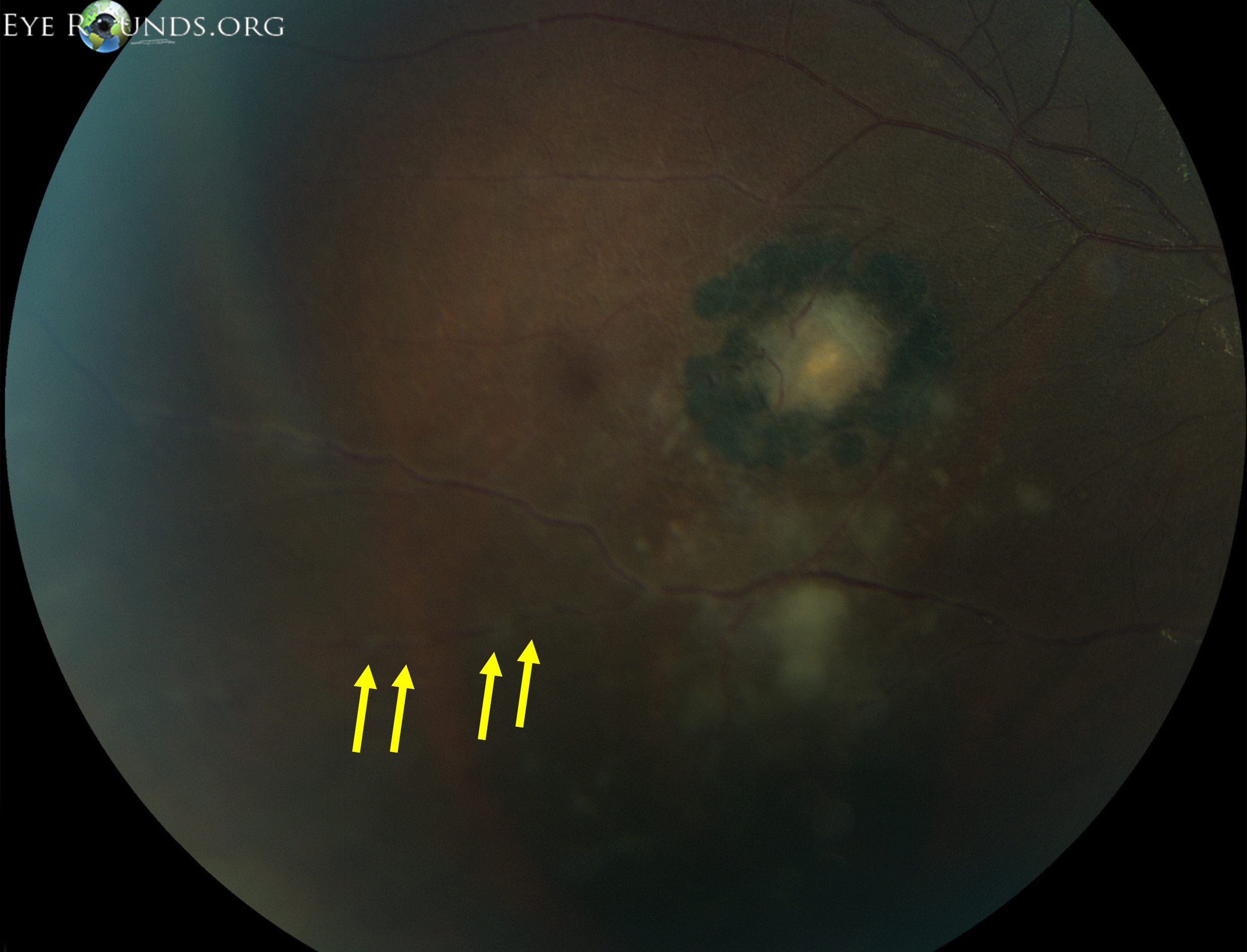 magnification inferotemporally showed an old pigmented scar with an adjacent area of active chorioretinitis. The yellow arrows point to faint Kyrieleis' vascular plaques.