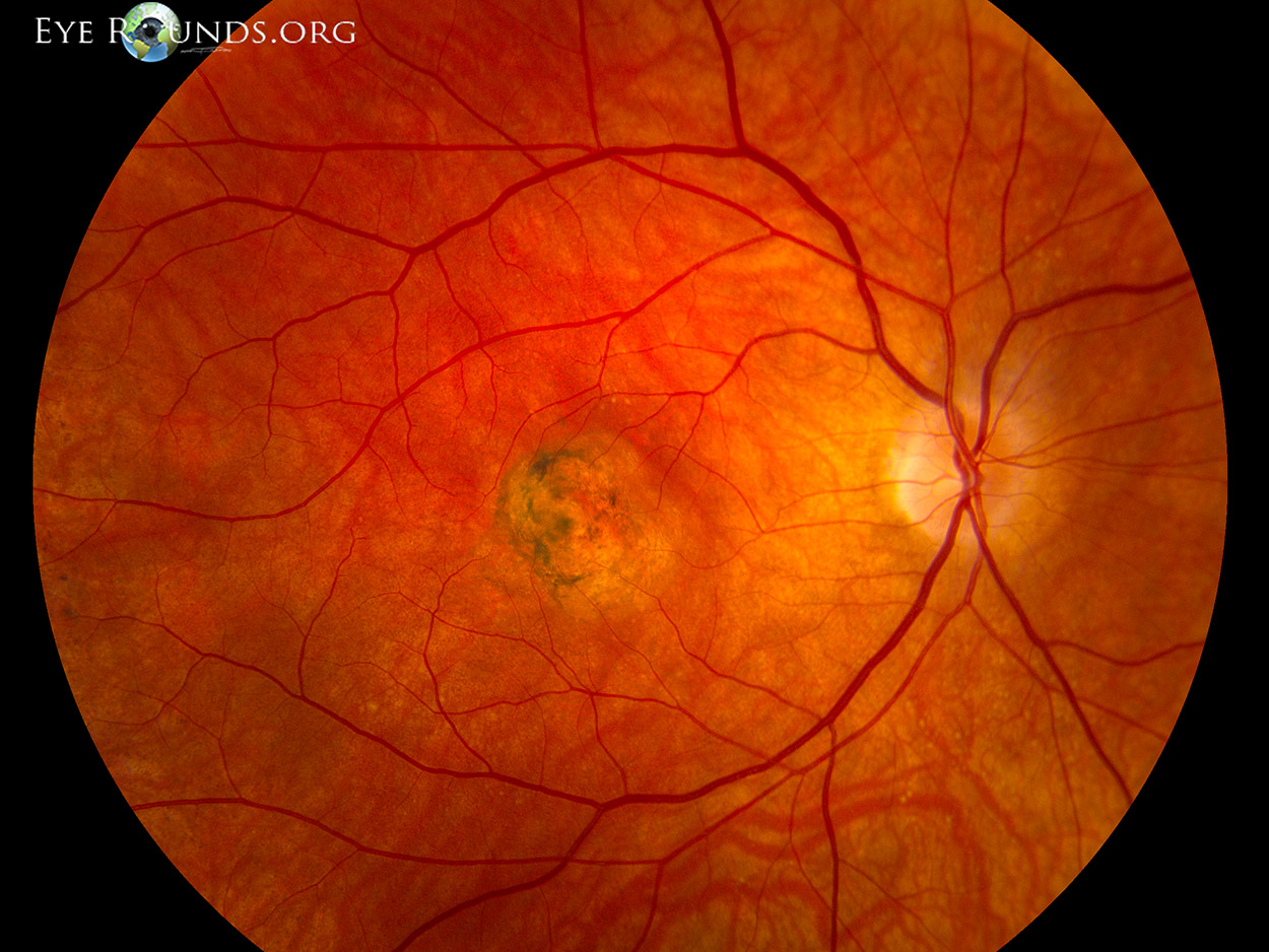 Fundus showing Sorsby macular dystrophy - right eye