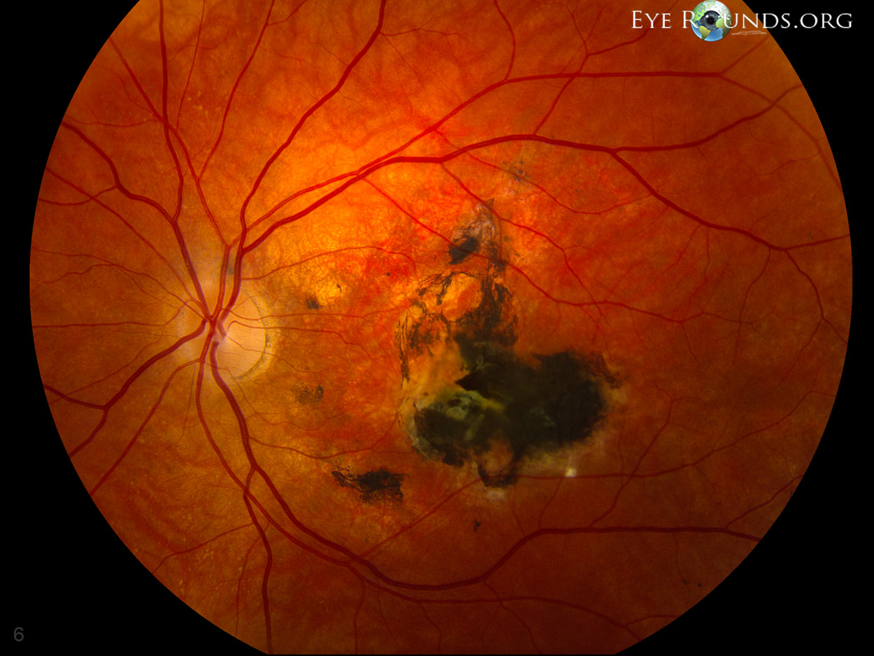 Fundus showing Sorsby macular dystrophy - left eye