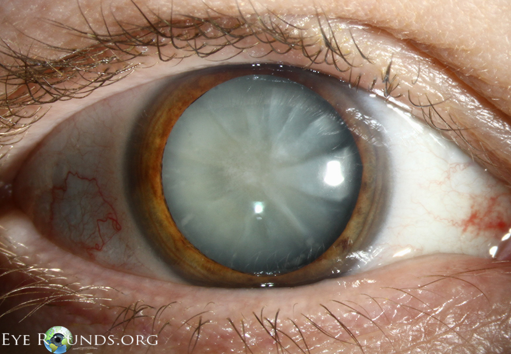 mature white cataract