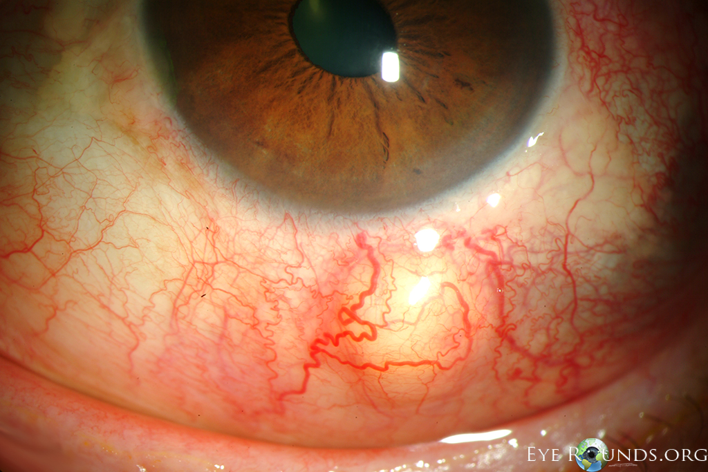 inflamed scleral vasculature and a prominent scleral nodule inferior to the limbus