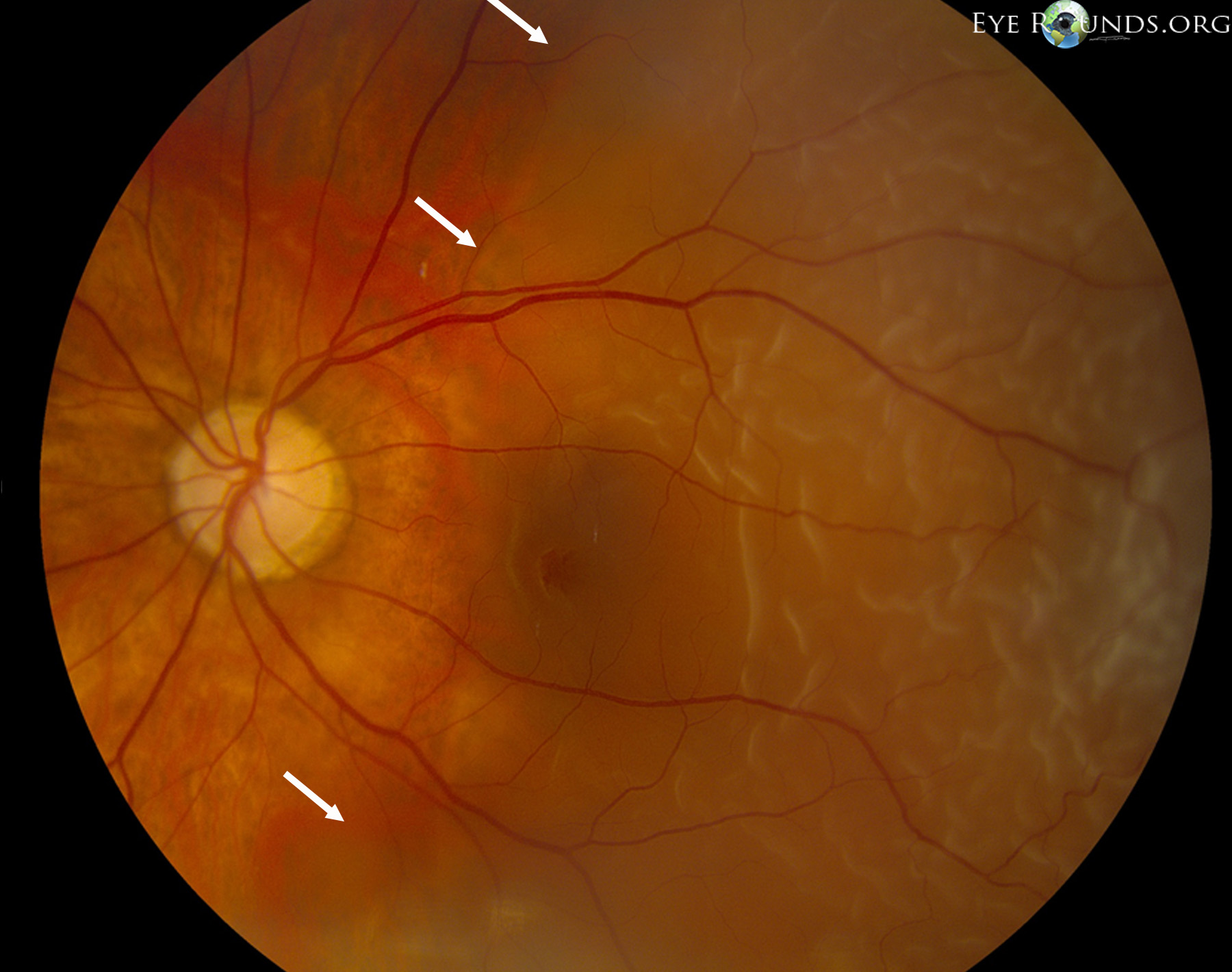 higher magnification of the rhegmatogenous retinal detachment