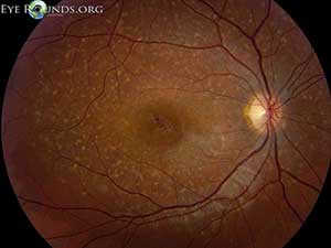 Stargardt Disease, right eye