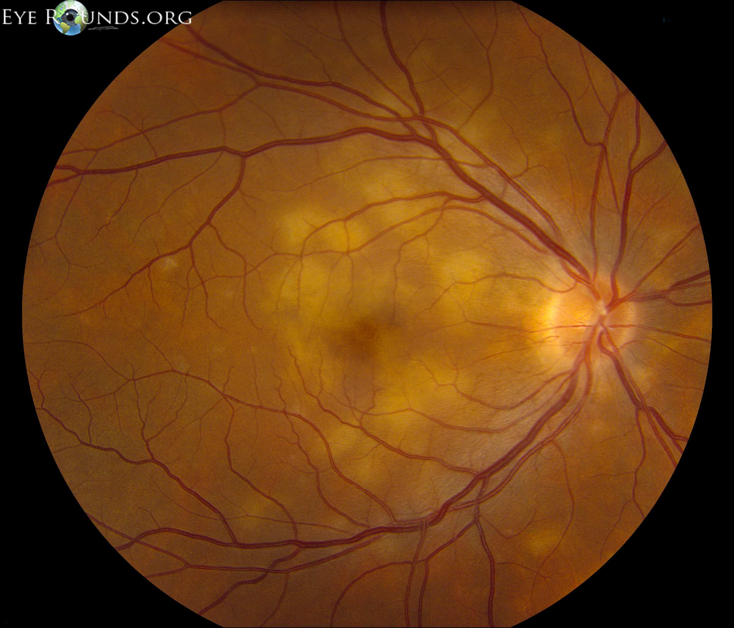 fundus image, yellow-white lesions throughout the macula
