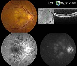 Acute posterior mulktifocal placoid pigment epitheliopathy (APMPPE)