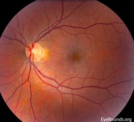 Acute Macular Neuroretinopathy (AMN)