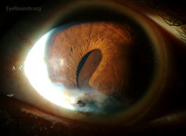 Adherent leukoma and epithelial inclusion cyst after penetrating trauma