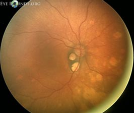 Aicardi Syndrome