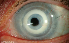AlphaCor keratoprosthesis