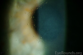 Polymorphic amyloid degeneration of the cornea