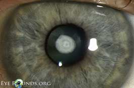 Anterior polar cataract