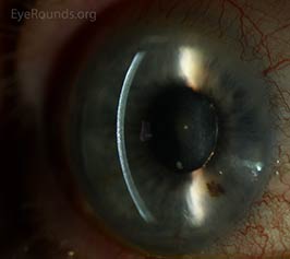 Subepithelial corneal haze after herpes zoster virus (HZV) keratitis