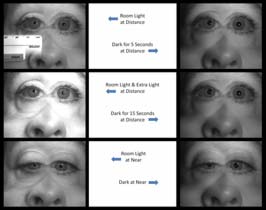 Apraclonidine Drop Testing for Horner Syndrome