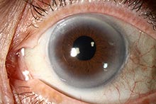 Corneal arcus, arcus senilis