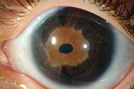Axenfeld-Rieger syndrome
