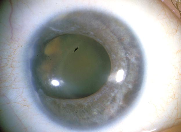 Axenfeld-Rieger Syndrome and Cataract