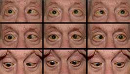 Bilateral cranial nerve VI (Abducens Nerve) palsies secondary to retroclival hematoma