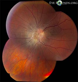 Combined Hamartoma of the Retina and RPE, Peri-Papillary