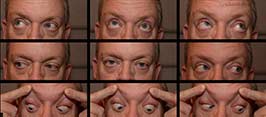 Cranial nerve IV (trochlear nerve) palsy