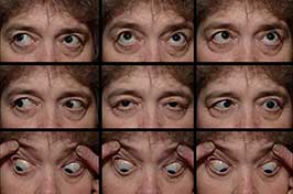 Cranial Nerve VI (Abducens Nerve) Palsy Schwannoma