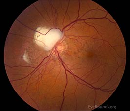 Involuted choroidal neovascular membrane (CNVM) mimicking a granuloma in pseudoxanthoma elasticum (PXE)