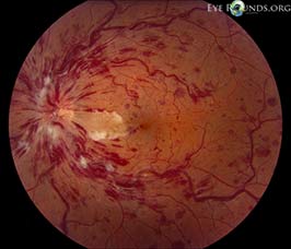 Central retinal vein occlusion with cilioretinal artery occlusion