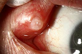Canalicular Benign Squamous Papilloma