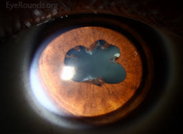 Central posterior synechiae (CPS) in the setting of tubulointerstitial nephritis and uveitis syndrome (TINU)