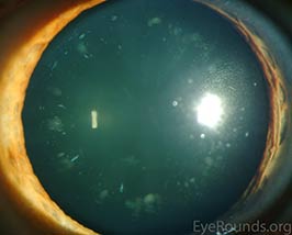 Cerulean cataract