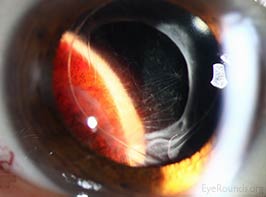 Ciliochoroidal Melanoma