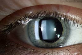 Clear crystalline lens, normal lens