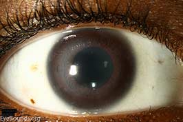Cogan Syndrome