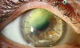 Confocal microscopy in fungal keratitis