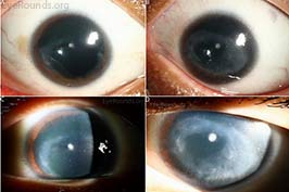 Congenital aniridia
